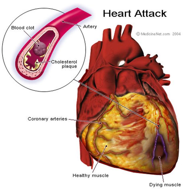 što oni rade u hitnoj sa srčanog udara kako bi potvrdili dijagnozu hipertenzije
