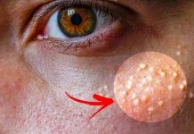 Ako imate ove bijele tačkice oko očiju, nemojte ih slučajno istiskivati, evo kako da ih se riješite
