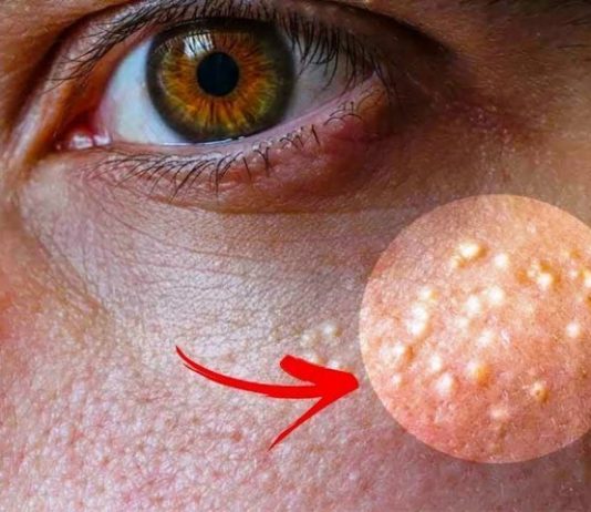 Ako imate ove bijele tačkice oko očiju, nemojte ih slučajno istiskivati, evo kako da ih se riješite