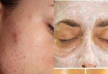 POMIJEŠALA JE 2 SASTOJKA I NAMAZALA NA BUBULJICE I MITISERE: Kad je oprala lice doživjela šok, OVO STVARNO DJELUJE