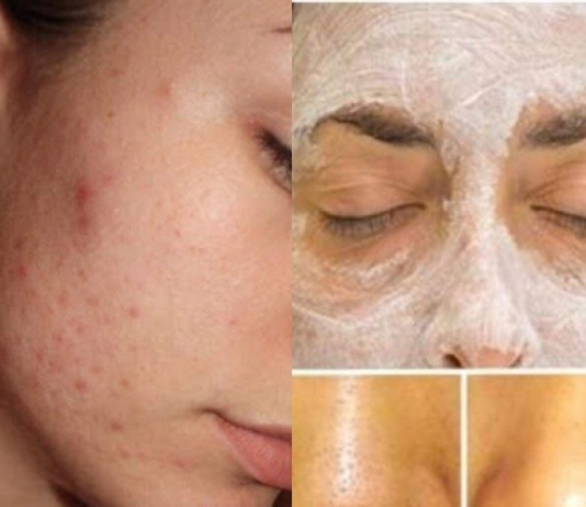 POMIJEŠALA JE 2 SASTOJKA I NAMAZALA NA BUBULJICE I MITISERE: Kad je oprala lice doživjela šok, OVO STVARNO DJELUJE