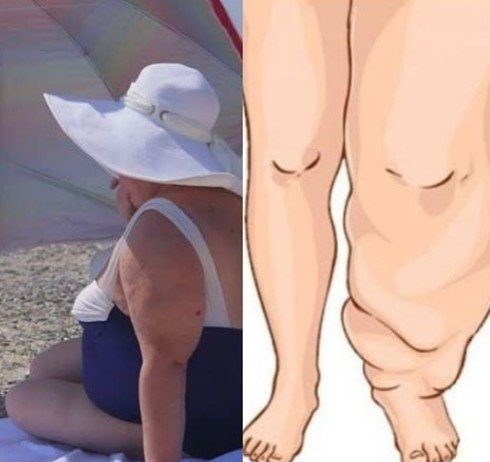 MOŽDA NISTE DEBELI, MOŽDA IMATE SAMO VIŠAK VODE U TIJELU: Izbacite 5 litara viška vode iz organizma za 3 dana! SMANJITE KILAŽU (RECEPT)