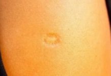 AKO STE ROĐENI U JUGOSLAVIJI, ONDA SIGURNO IMATE OVAJ OŽILJAK NA RUCI: Znate li od čega?