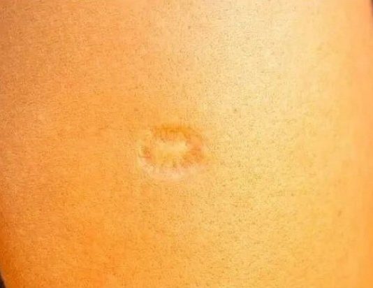 AKO STE ROĐENI U JUGOSLAVIJI, ONDA SIGURNO IMATE OVAJ OŽILJAK NA RUCI: Znate li od čega?