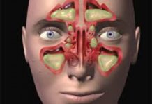 NAJBOLJI NAČIN DA OČISTITE SINUSE OD GNOJA I SLUZI: Za 10 dana ćete disati punim plućima! (RECEPT)